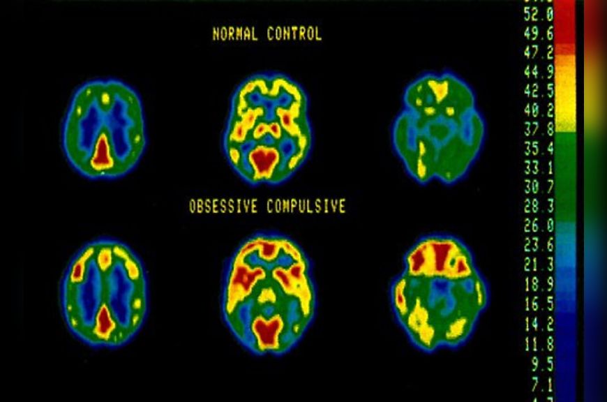Per Yale University - a scan of an OCD brain and a control brain.